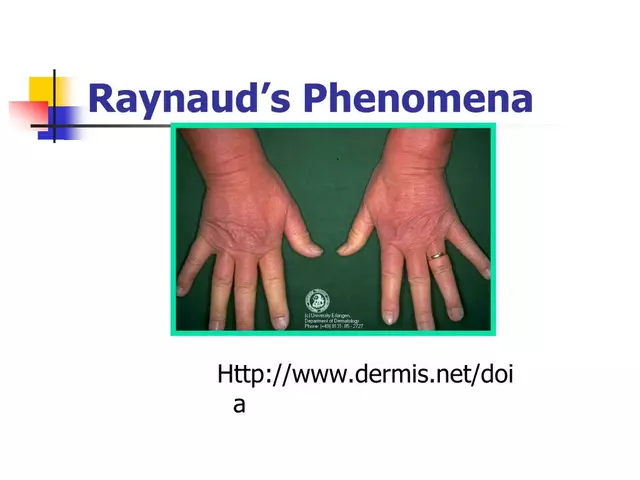 Baclofen for Raynaud's Phenomenon: Can It Help?