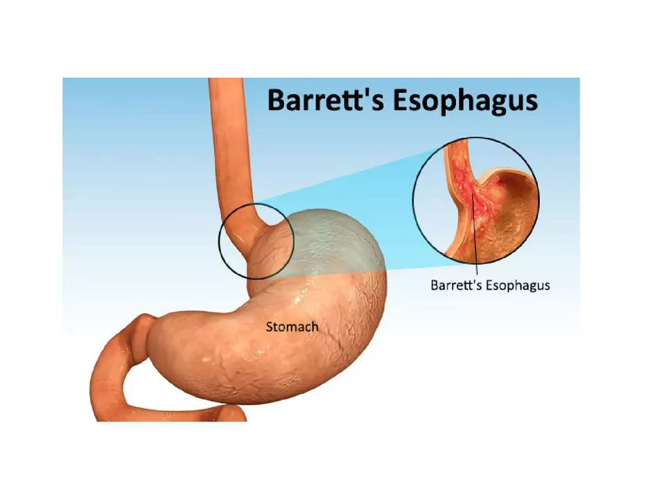 The effectiveness of Lansoprazole for treating Barrett's esophagus