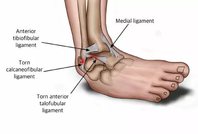 How to Tell If Your Sprain Has Turned Into a Chronic Injury