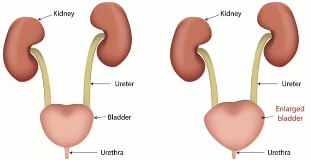 The Benefits of Bladder Training for Overcoming Urinary Retention