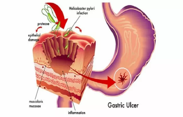 The link between ulcers and Helicobacter pylori infection